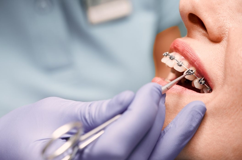 Thời gian niềng răng nhanh nhất là bao lâu 1