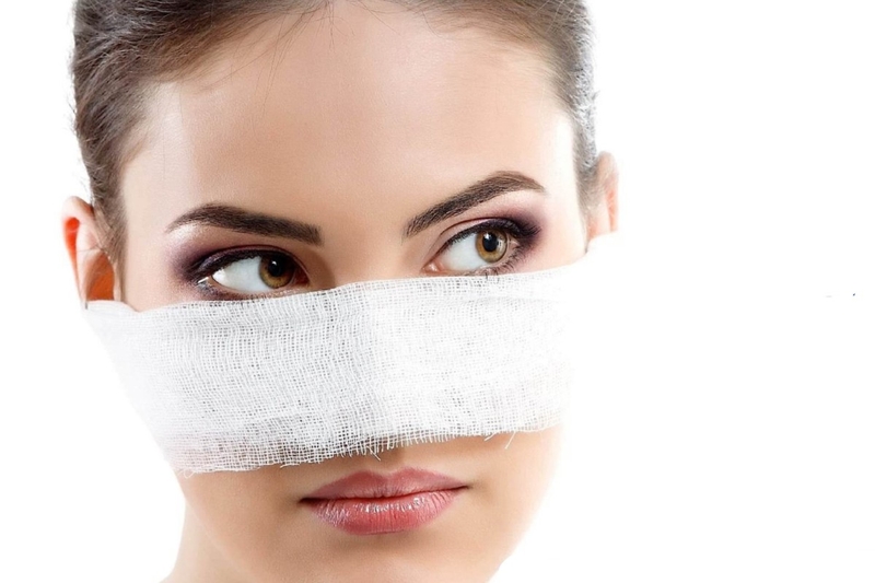 Thời gian sưng mũi trong bao lâu? Cách giảm sưng sau nâng mũi 1