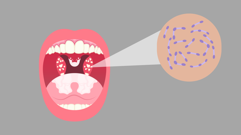 Thời gian ủ bệnh bạch hầu bao lâu? Biện pháp phòng ngừa bệnh 1
