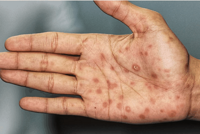 Tìm hiểu về bệnh giang mai