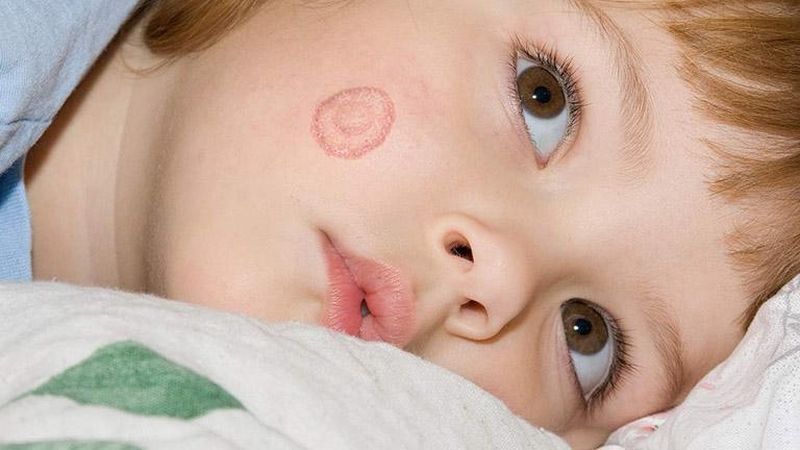 Thời gian ủ bệnh hắc lào bao lâu? Cần lưu ý điều gì 1