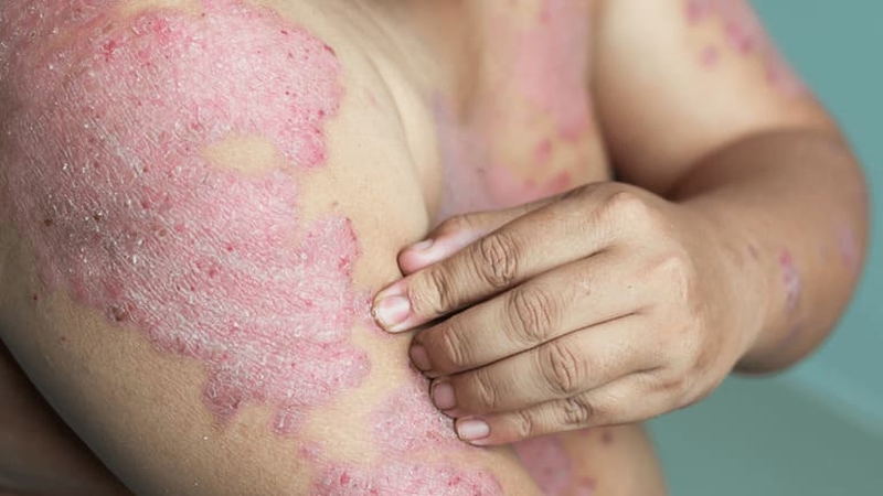 Thời gian ủ bệnh hắc lào bao lâu? Cần lưu ý điều gì 2