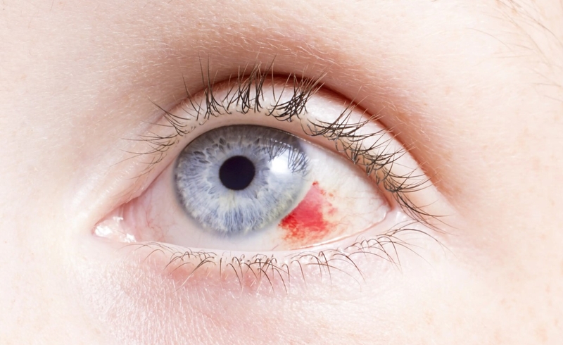 Thói quen dụi mắt có tốt không? Làm thế nào để hạn chế thói quen này 2