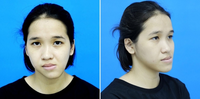 Thói quen nhai một bên có tác hại gì? Cách khắc phục như thế nào? 1