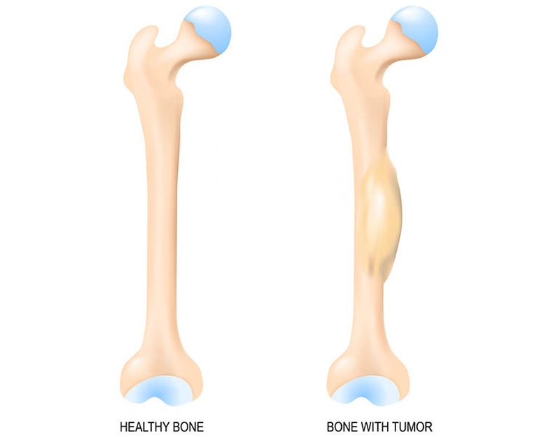 Thống kê mới nhất về Ewing Sarcoma ở trẻ em và thanh thiếu niên 1