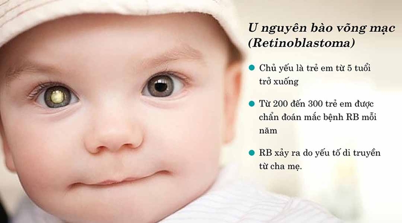 Thống kê và nghiên cứu mới nhất về bệnh U nguyên bào võng mạc ở trẻ em 2