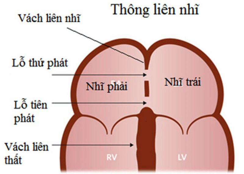 Thông liên nhĩ lỗ thứ phát có nguy hiểm không? 3
