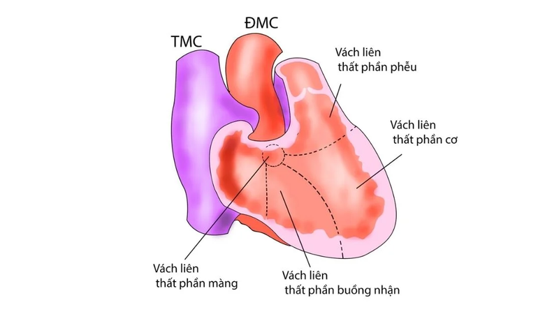 Thông liên thất phần phễu: Triệu chứng, nguyên nhân và cách điều trị bệnh 2