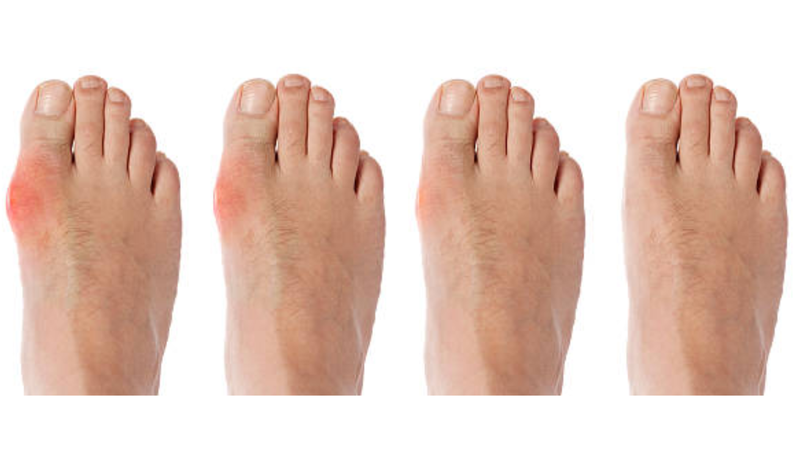 Thống phong là bệnh gì? Liệu bạn có đang mắc phải? 3