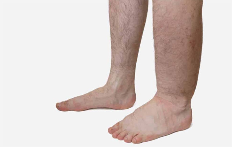 Thông tin sức khỏe: Loài giun nào gây ra bệnh chân voi ở người1