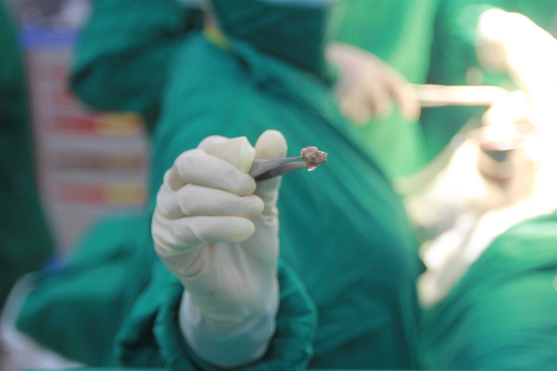 Thông tin từ A đến Z về điều trị sỏi ống tụy mà bạn nên biết 2