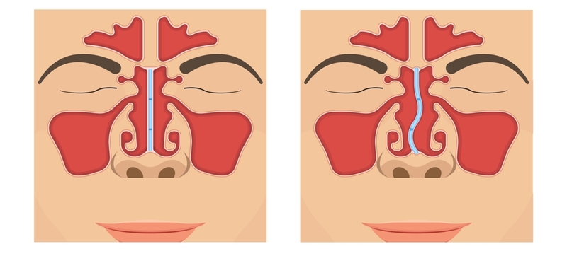 Hỏi đáp: Thu nhỏ đầu mũi có vĩnh viễn không 2