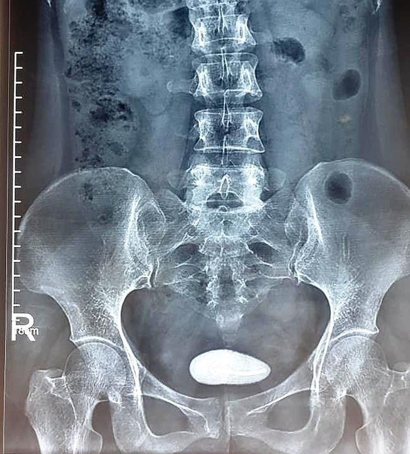 Thủ phạm gây nên sỏi thận ở trẻ em và cách phòng tránh 3