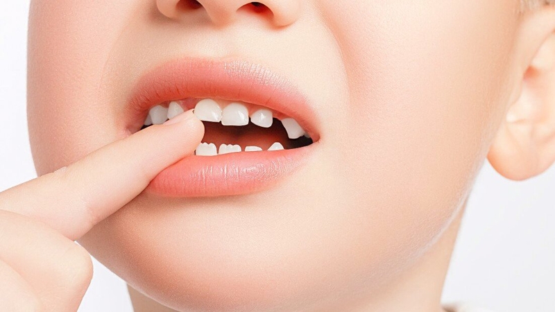 Thứ tự mọc răng sữa ở trẻ mà bố mẹ nên biết 1
