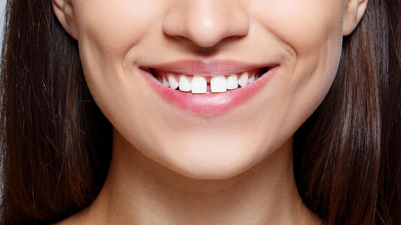 Thức ăn giắt vào kẽ răng do đâu? 1