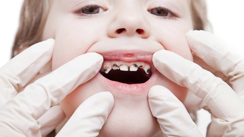 Thức ăn giắt vào kẽ răng do đâu? 2