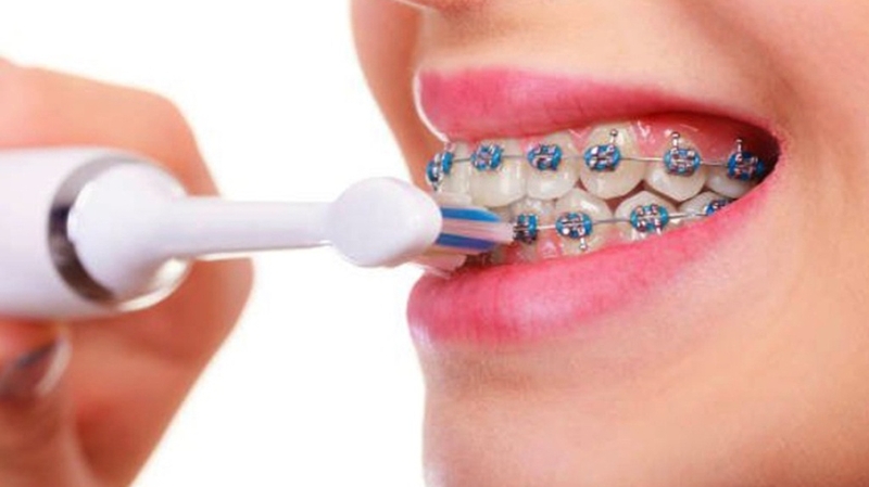 Thực đơn 7 ngày cho người niềng răng: Bí quyết ăn ngon, khỏe đẹp 4