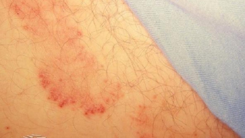 Thực hư chuyện bệnh hắc lào gây vô sinh 1