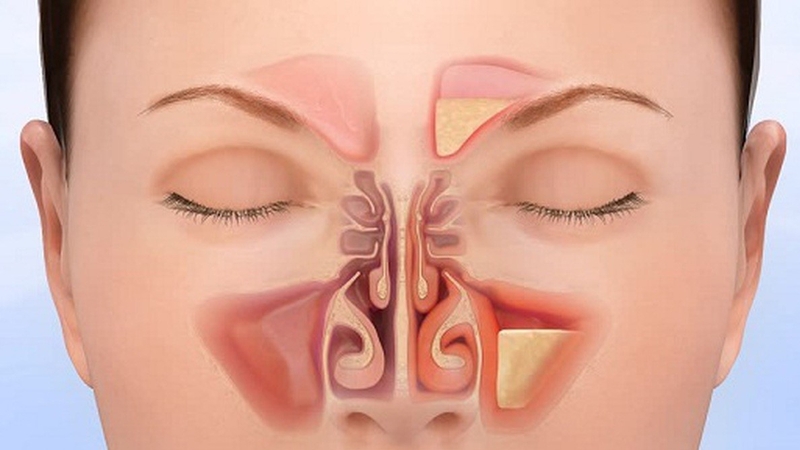 Dùng cây giao chữa viêm xoang có hiệu quả không? 0