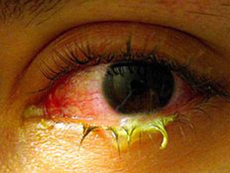 Thực hư chuyện mật ong chữa đau mắt đỏ 1