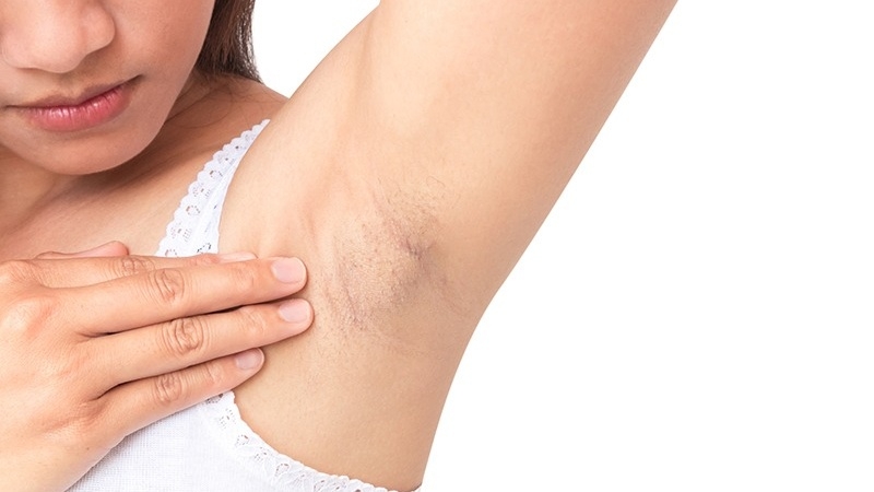 Giải đáp: Cạo lông nách có bị hôi nách không? 1
