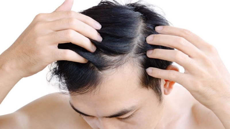 Thực hư thảo dược trắc bá diệp trị rụng tóc ở nam giới 3