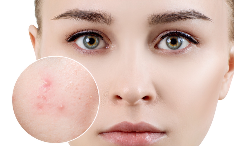 Thực hư về Betacylic có trị mụn không? Bí kíp giữ cho da sạch mụn ngay tại nhà  1