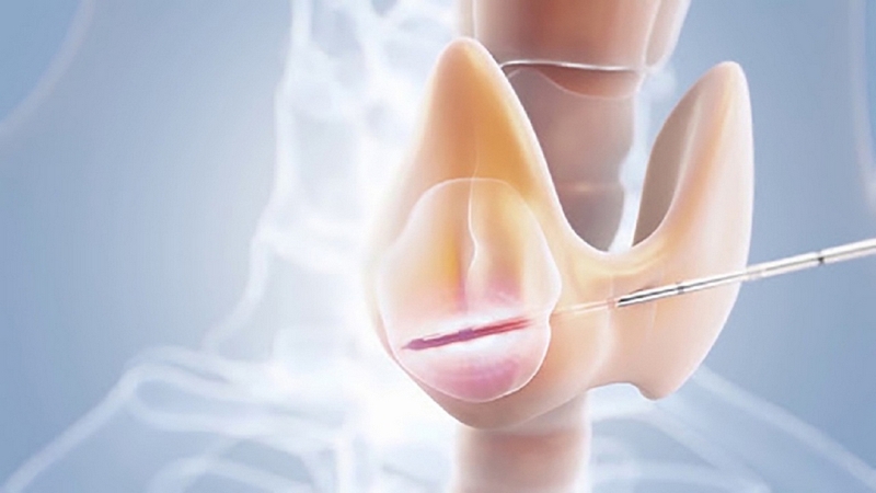 Thực hư về chữa u tuyến giáp bằng cách dân gian có an toàn không? 2