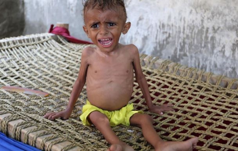 Thực trạng suy dinh dưỡng trên thế giới dưới 5 tuổi và giải pháp phòng chống 2