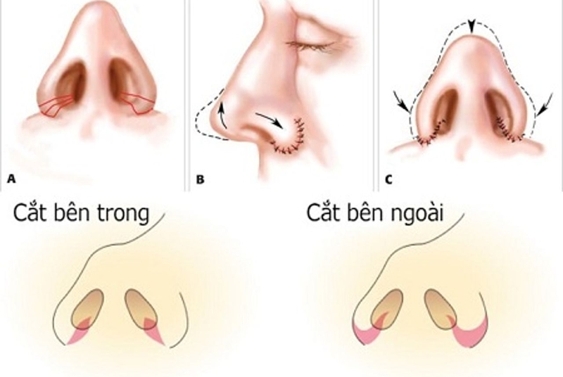 Hỏi đáp: Phẫu thuật cắt cánh mũi có để lại sẹo không 1