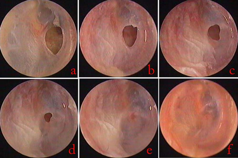 Thủng màng nhĩ có bị điếc không? Các phương pháp điều trị 3