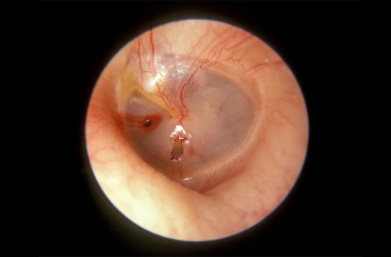 Thủng màng nhĩ có vá được không? 1