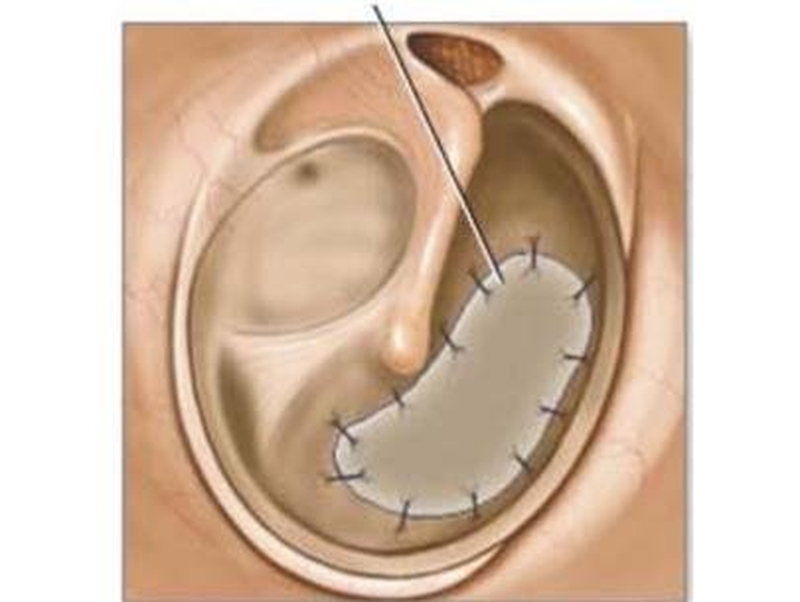Thủng màng nhĩ có vá được không? 2