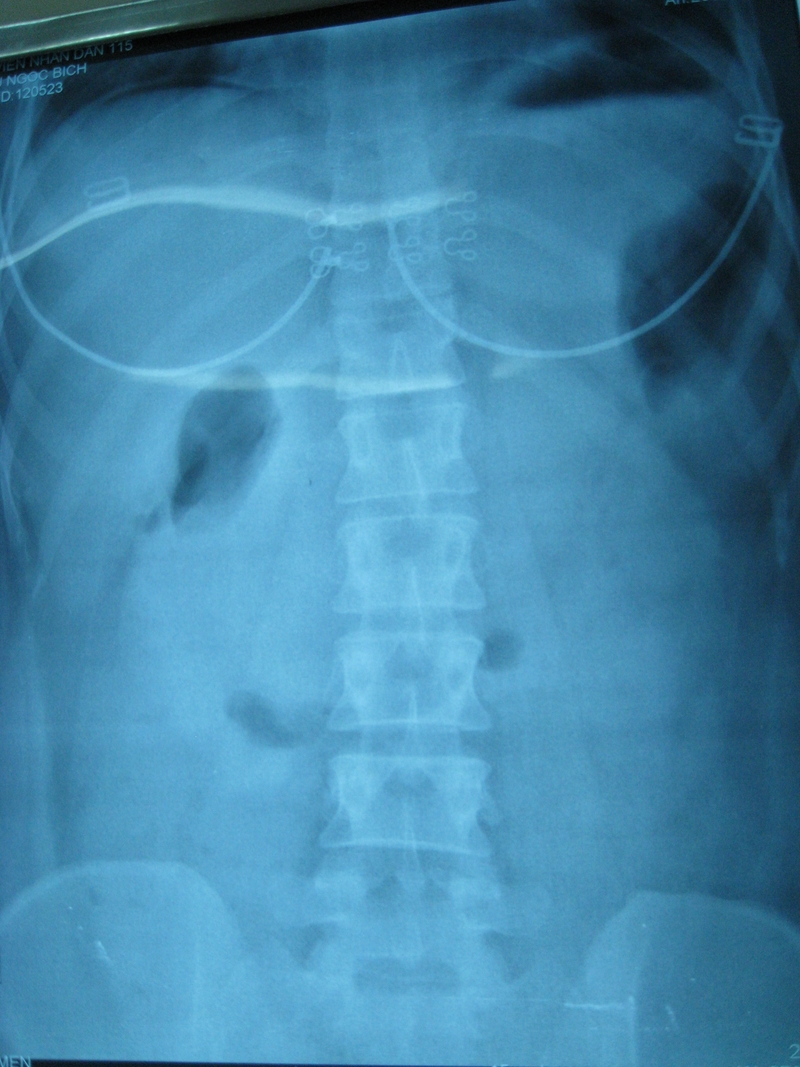 Thủng tạng rỗng: Triệu chứng, nguyên nhân và điều trị 2