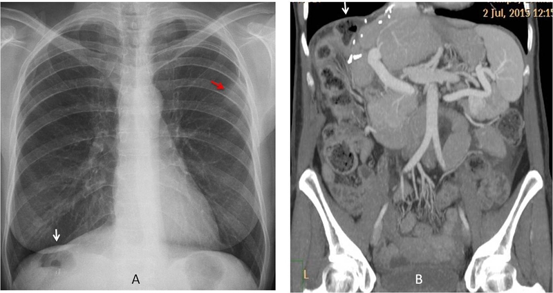 Thủng tạng rỗng: Triệu chứng, nguyên nhân và điều trị 4