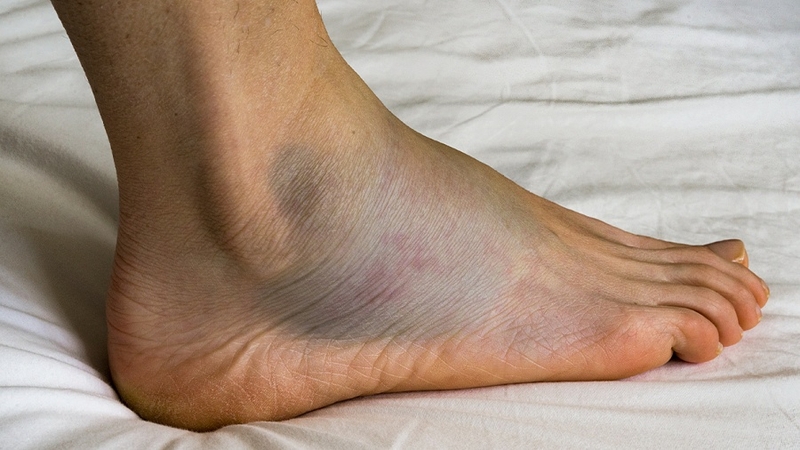 Thuốc Alphatrypa dùng trong điều trị kháng viêm và giảm phù nề 2