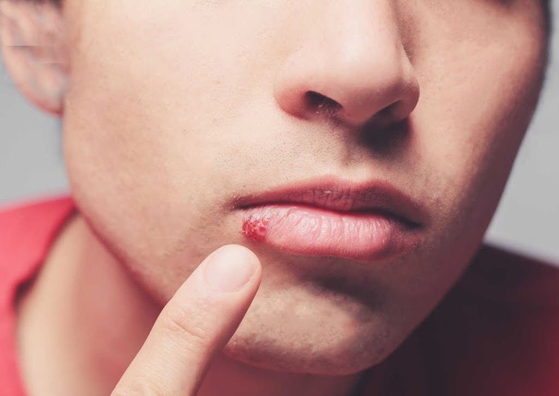 Thuốc bôi chốc mép và những lưu ý khi sử dụng thuốc bôi chốc mép 1