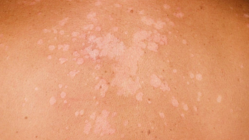 Lang ben do nấm Malassezia furfur gây ra