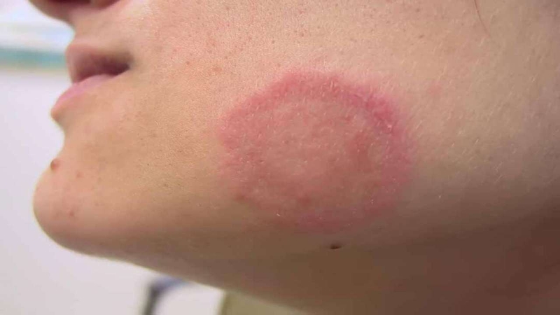 Thuốc bôi lang beng đỏ hiệu quả nhất 1