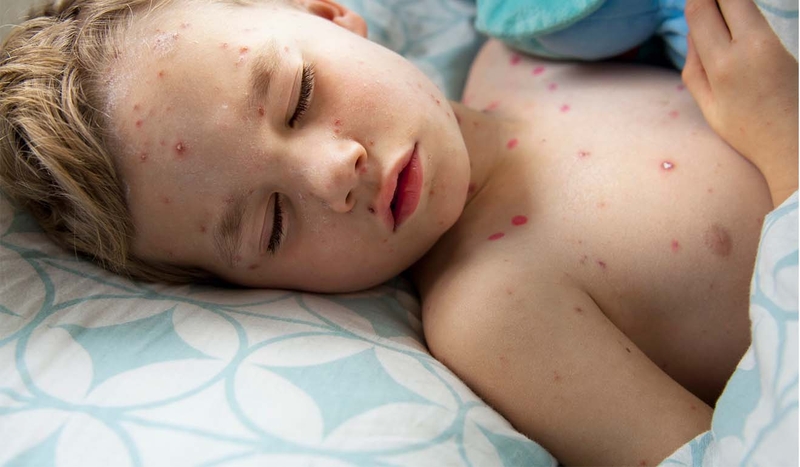 Thuốc bôi thủy đậu xanh methylen phổ biến