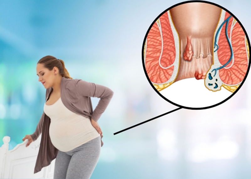Bị trĩ khi mang thai có thể khỏi hoàn toàn