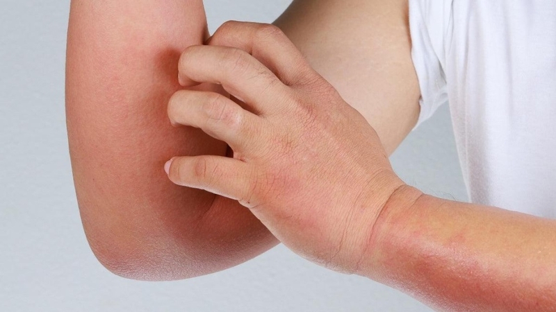 Thuốc chống dị ứng: Giải pháp hiệu quả cho các triệu chứng dị ứng 1