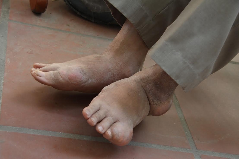 Thuốc chữa bệnh gút của Mỹ - Hiệu quả mang lại ngoài mong đợi 1