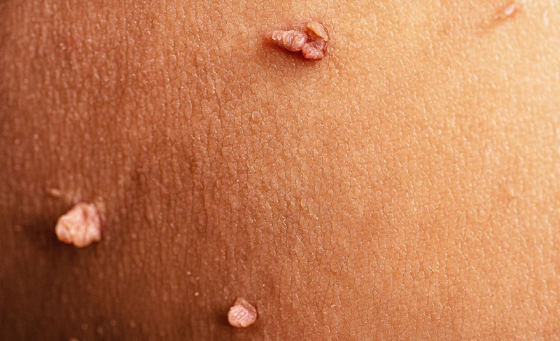 Tìm hiểu về thuốc chữa sùi mào gà giai đoạn đầu 1