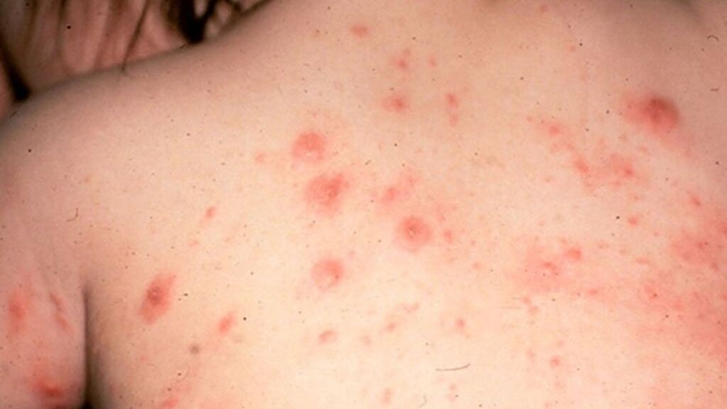 Thuốc đặc trị ghẻ ngứa ở trẻ em - Giải pháp hiệu quả cho vấn đề da dị ứng 1