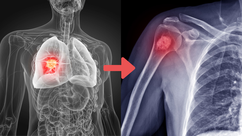 Thuốc điều trị di căn xương: Hiệu quả và tác dụng phụ cần lưu ý 1