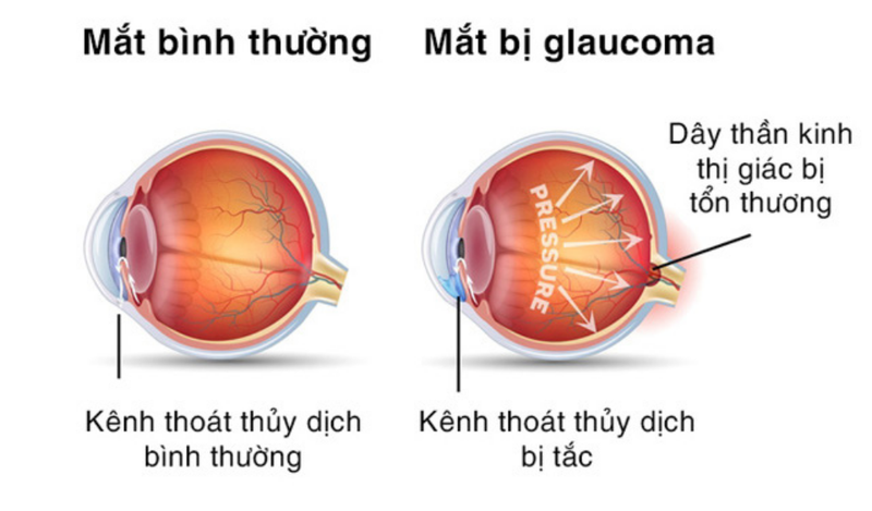 Nguyên nhân glaucoma