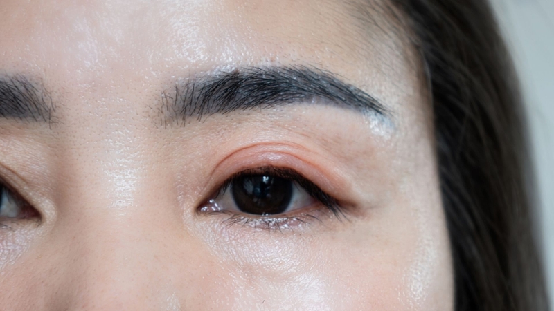 Hạn chế trang điểm mắt khi đang bị viêm bờ mi để tránh kích ứng