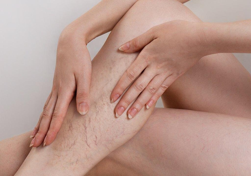 Thuốc giãn tĩnh mạch và tác dụng phụ của thuốc giãn tĩnh mạch 1