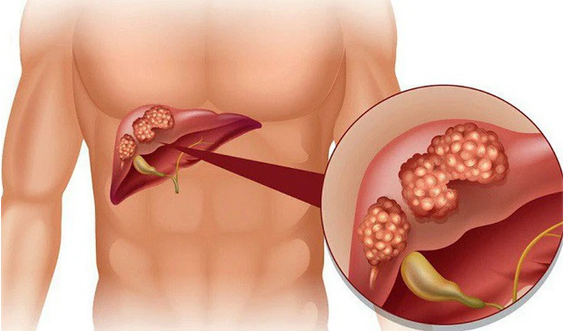 Tế bào ung thư vú di căn